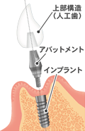 インプラントの前準備とオペ